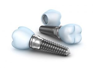 Considering an upgrade to dental implants