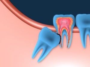'impacted wisdom tooth'