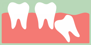cartoon of an impacted tooth