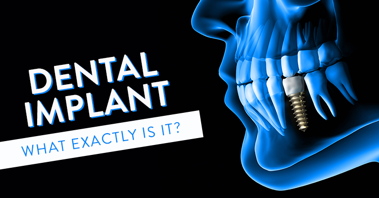 what exactly is a dental implant