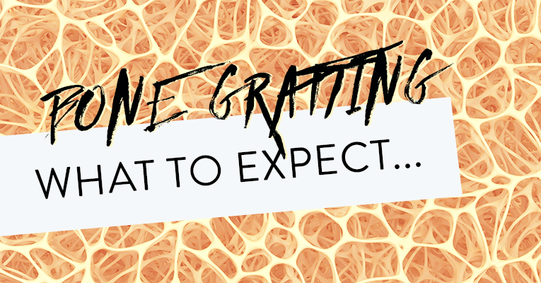 bone grafting- what to expect