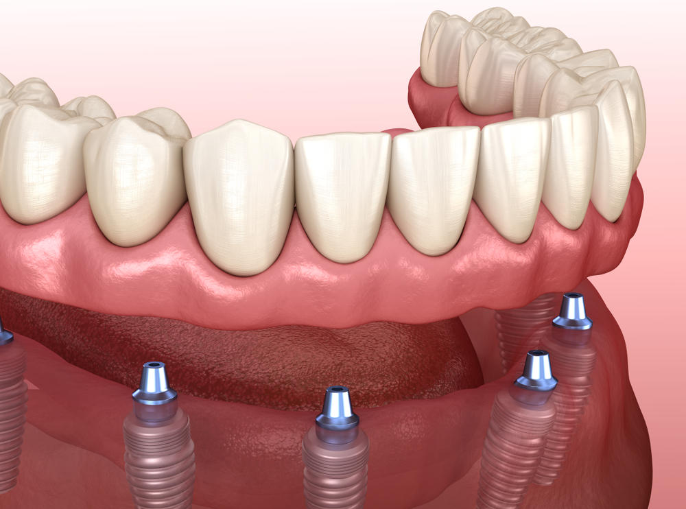 Digital image of dental implants